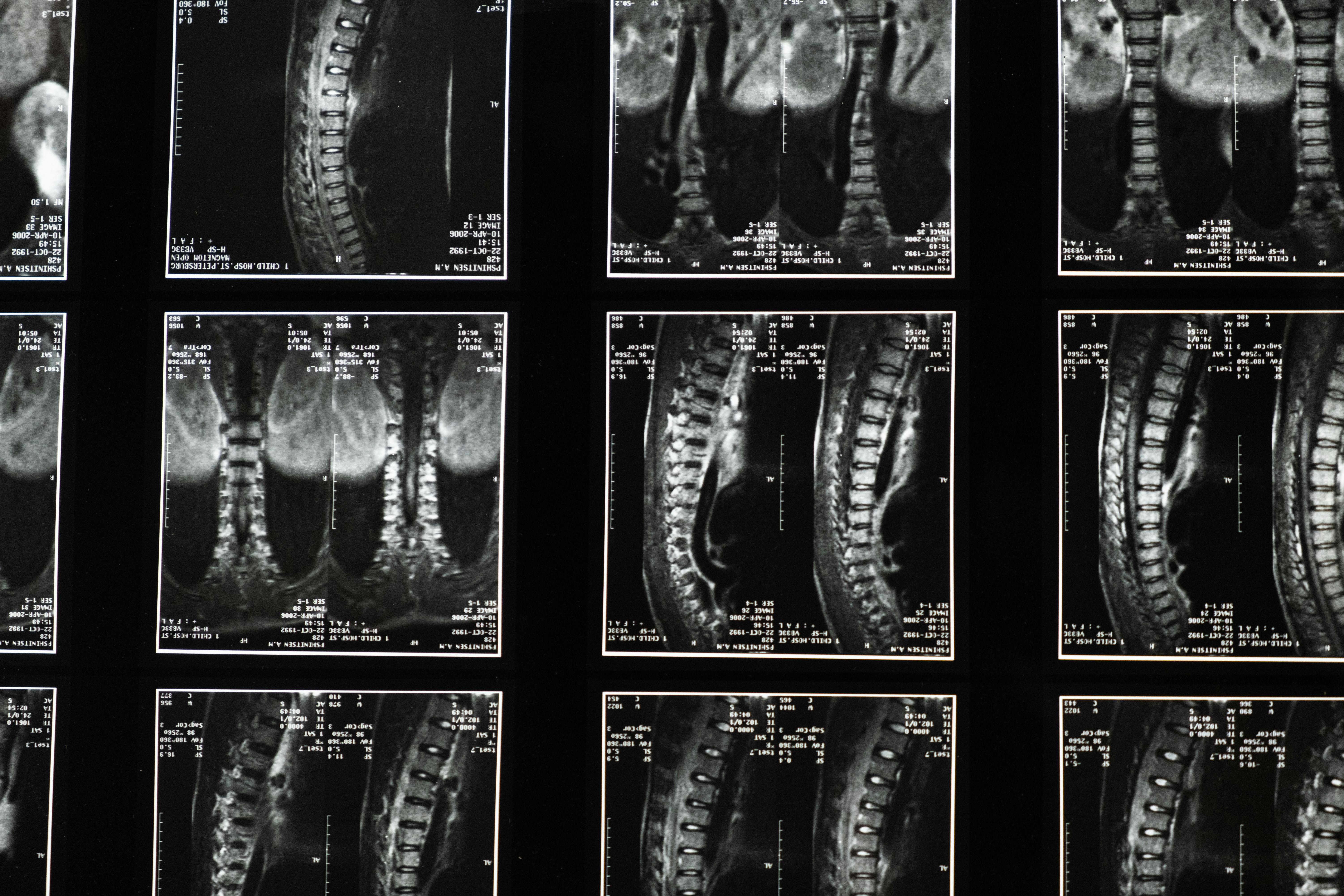Chest X-ray Disease Classifier